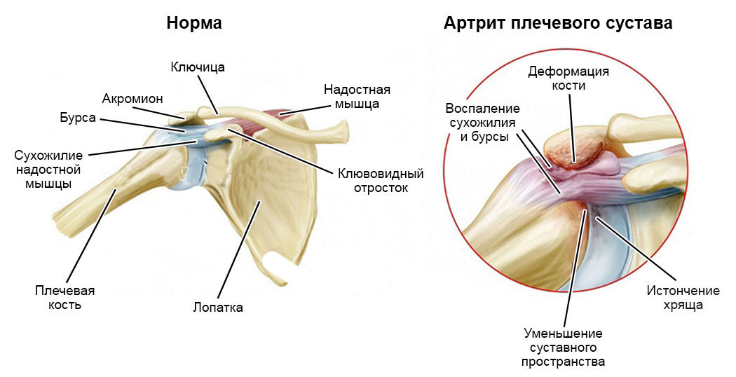 Боль в плечевом суставе правой руки. Лопаточно-плечевой артрит. Ревматоидный артрит плеча. Строение плечевого сустава человека и болезни. Артропатия плечевого сустава лекарства.