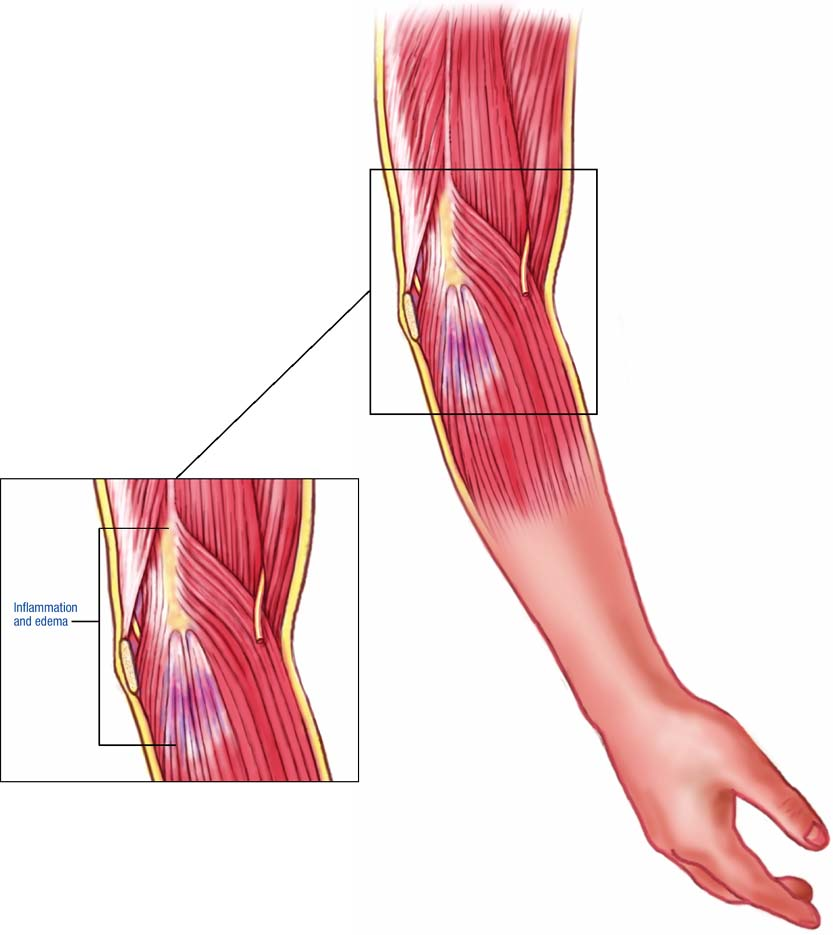 Локтевой сустав мышцы и сухожилия. Тендинит (воспаление сухожилия). Тендинит сухожилия трехглавой мышцы локтевого сустава. Тендинит трицепса. Тендинит трицепса в локтевом суставе.