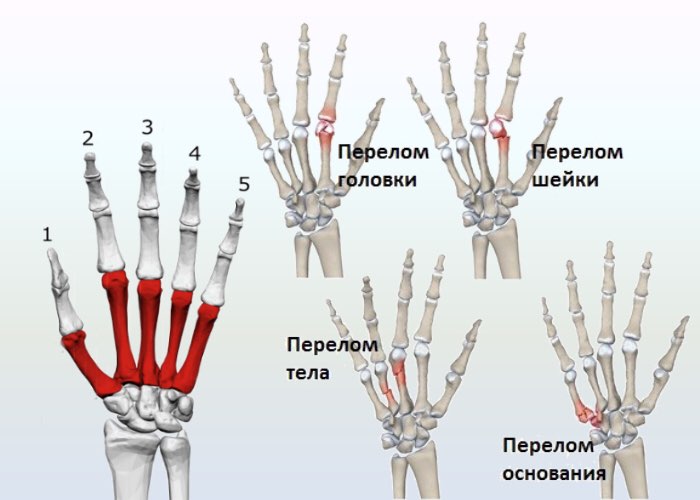 Перелом кости запястья реабилитации