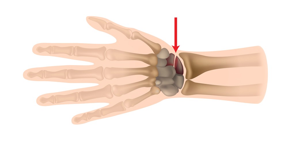 Перелом ладьевидной кости кисти руки фото