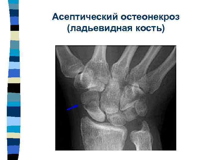 Где находится ладьевидная кость