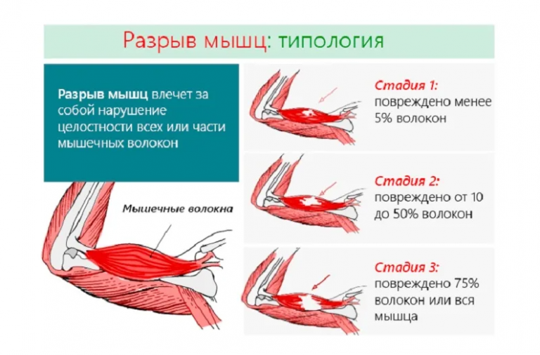 Разрыв мышцы на ноге фото