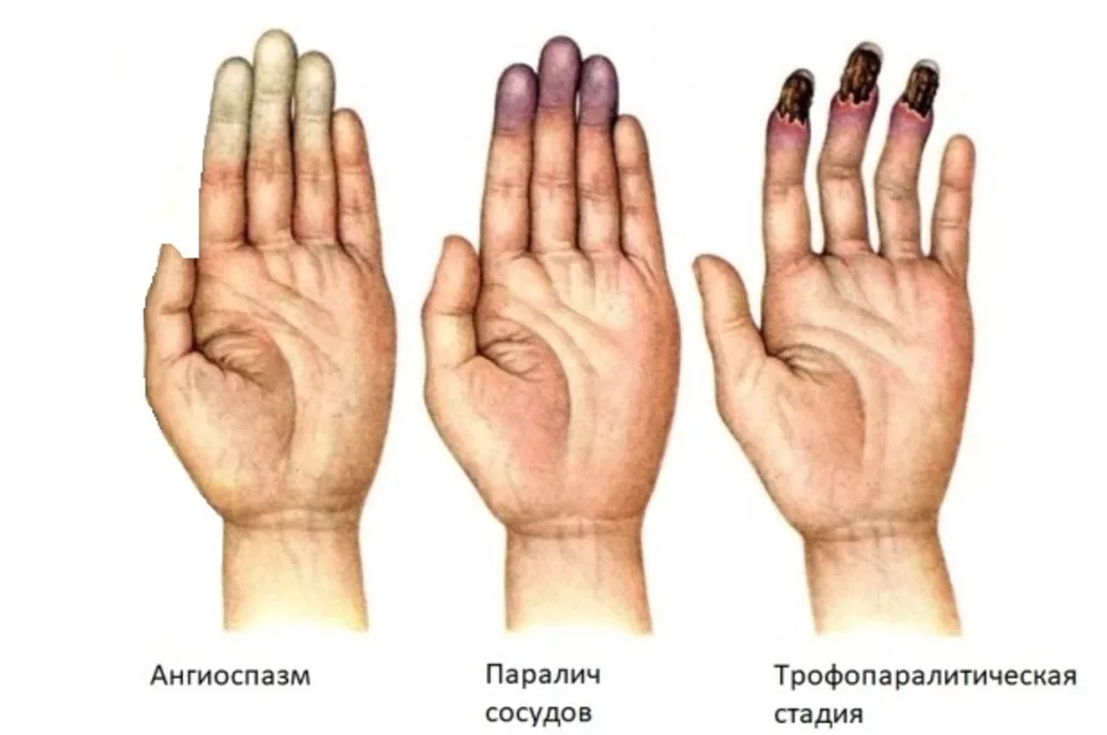 Поражение первой степени. Вибрационная болезнь синдром Рейно. Синдром Рейно некроз пальца.